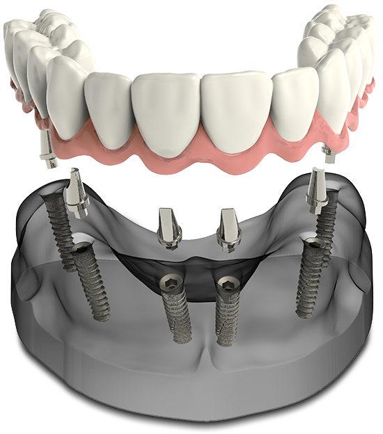 full arch dental implant model