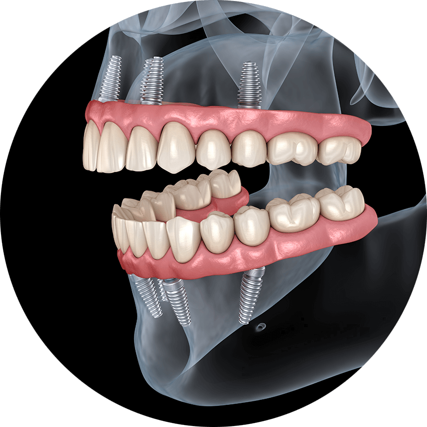 dental implants in chico ca