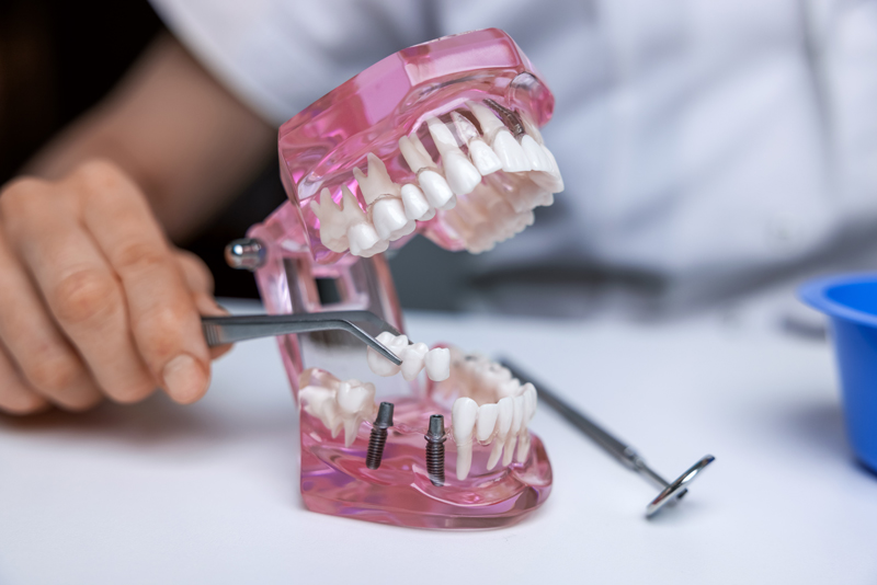 dental implants in chico ca