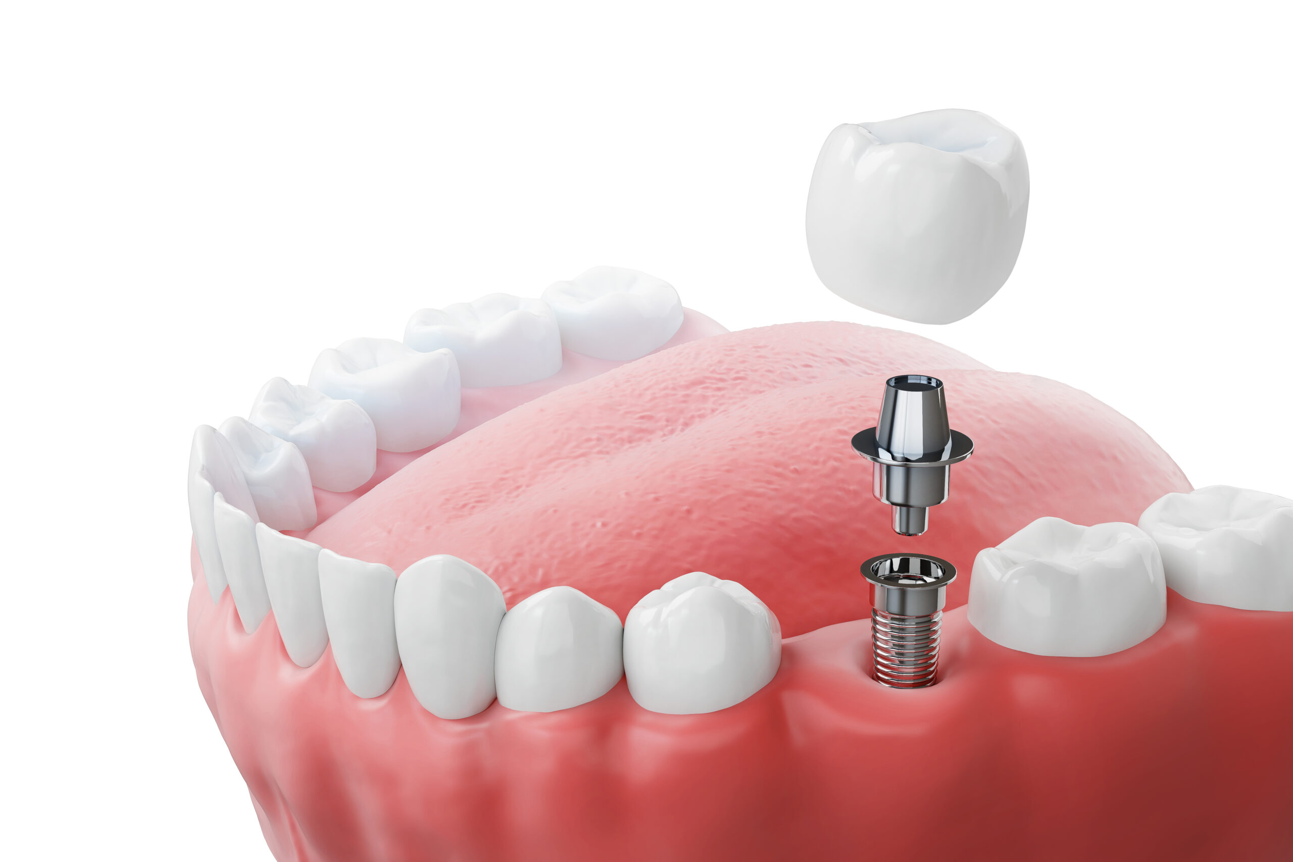 abutments for dental implants