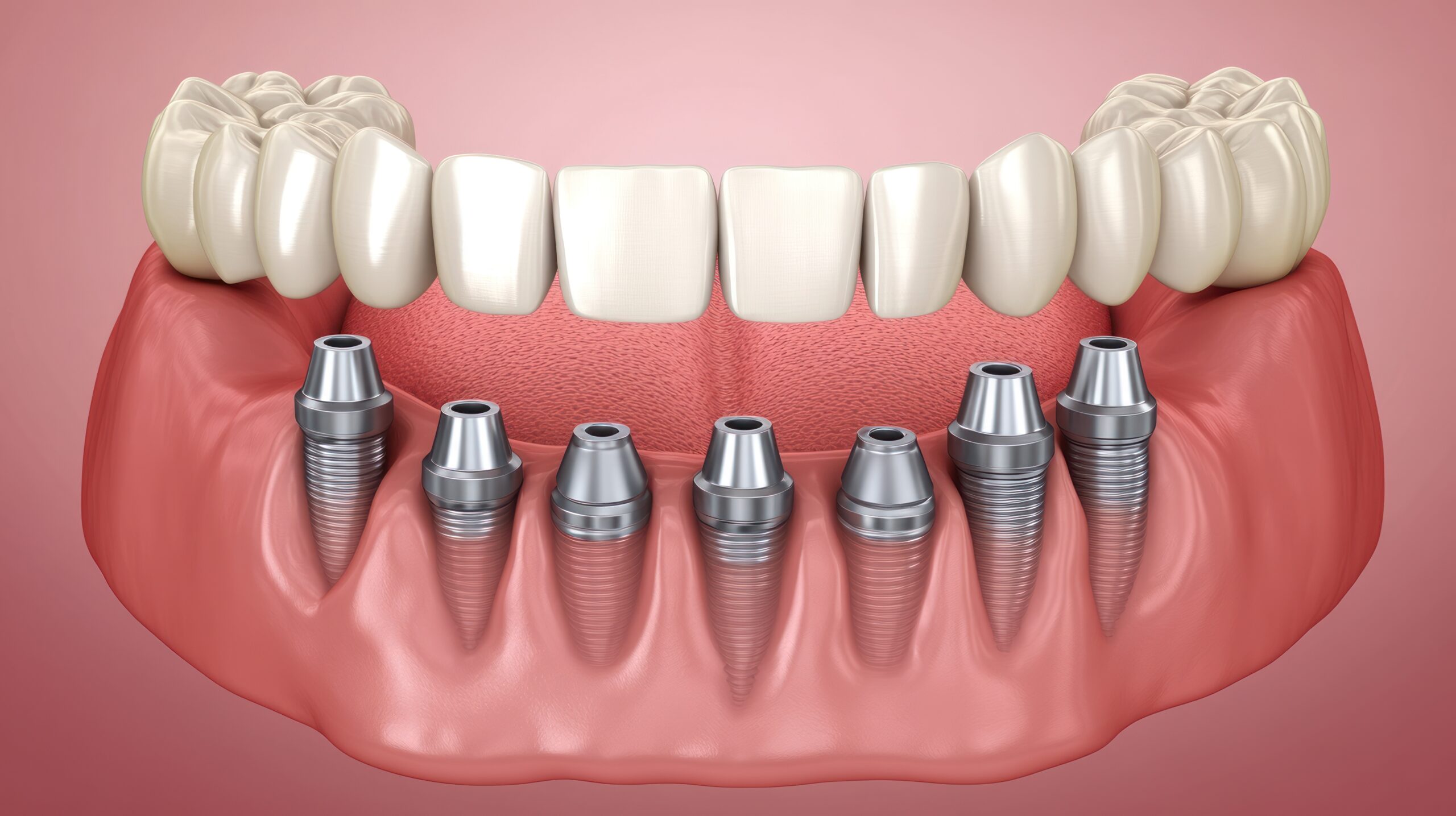 facts about dental implants