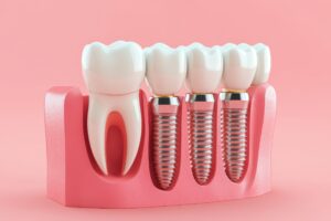 How to Care for Full Mouth Dental Implants