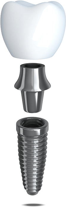 same day dental implants