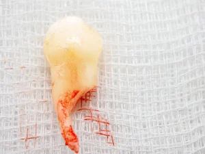 extracting broken teeth