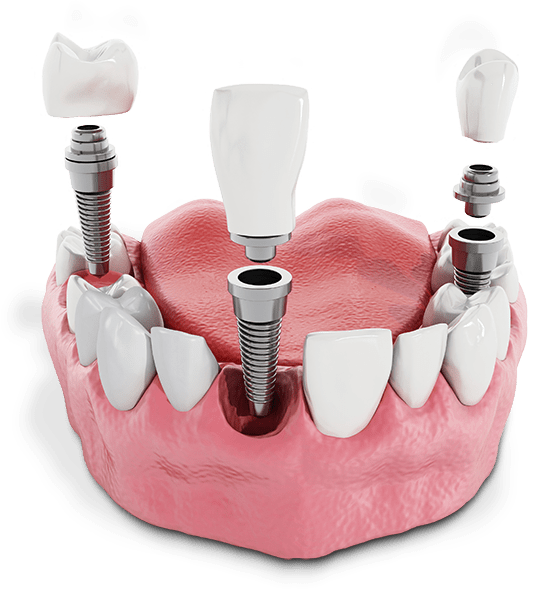 Dental Implant Experts